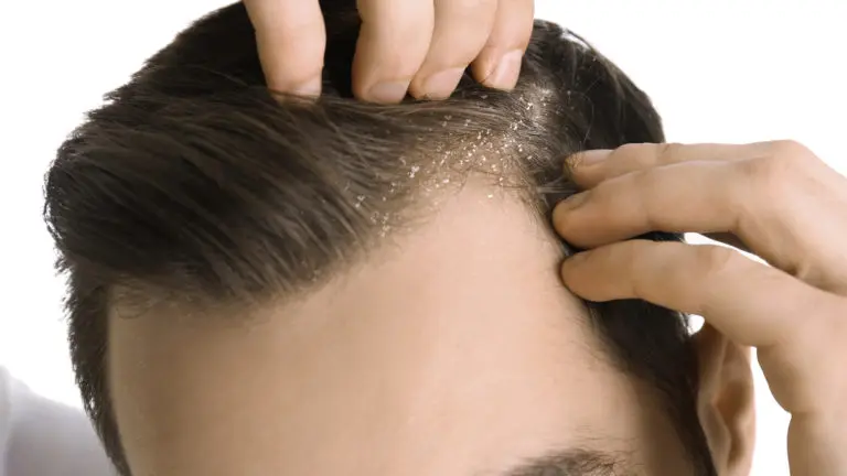 Say Goodbye to Dandruff with These Simple Home Remedies