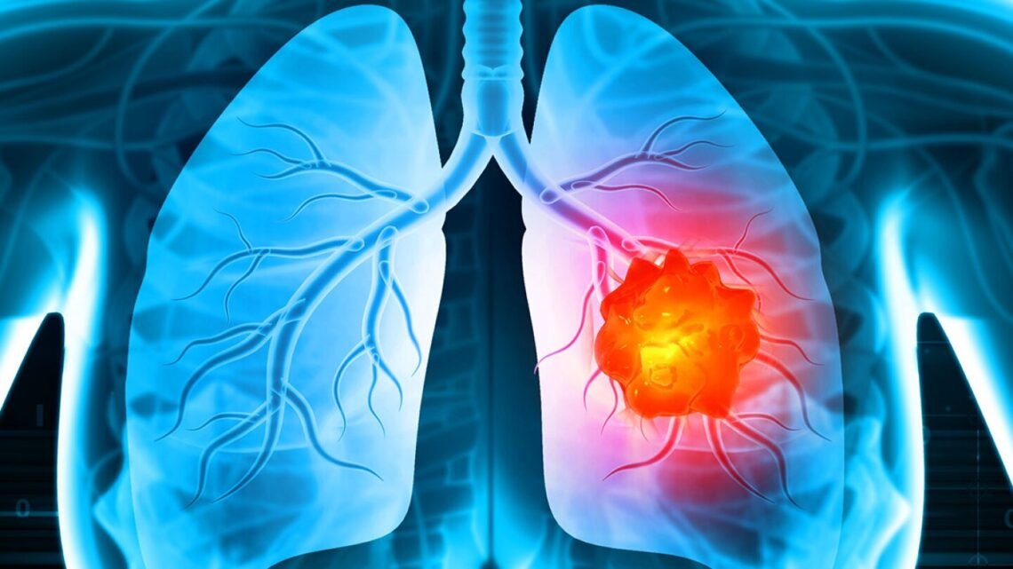 Signs Of Lung Cancer