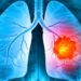 Signs Of Lung Cancer