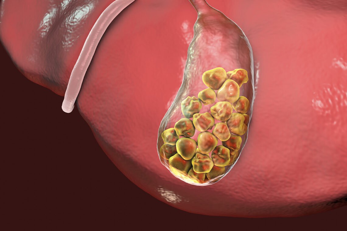 Relief from Gall Bladder Stones