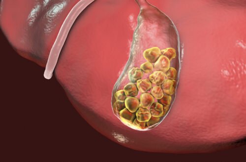 Relief from Gall Bladder Stones