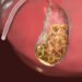 Relief from Gall Bladder Stones