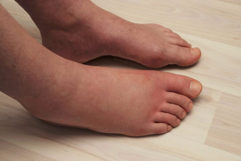 Swelling in Your Feet