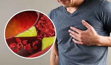 Naturally Lower High Cholesterol Levels