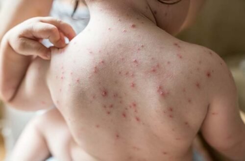 Treat Chicken Pox