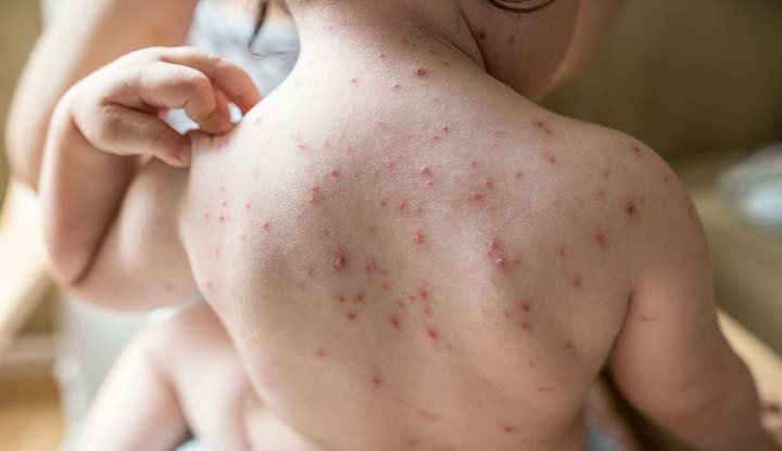 Treat Chicken Pox